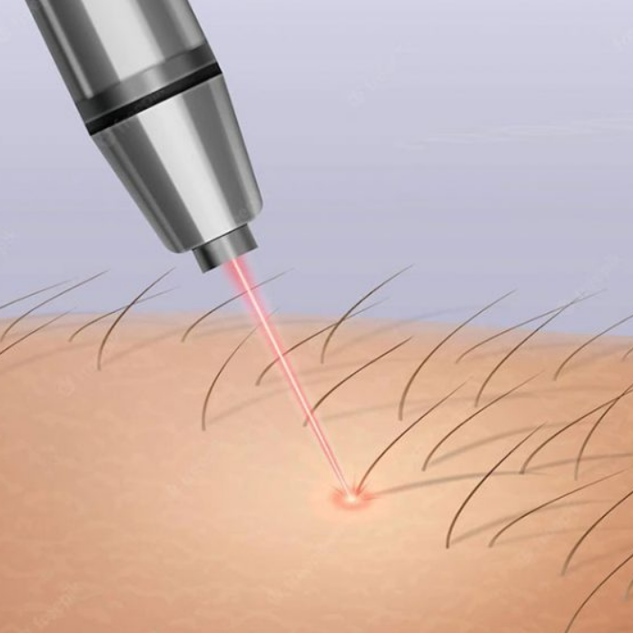 Laser Hair Removal